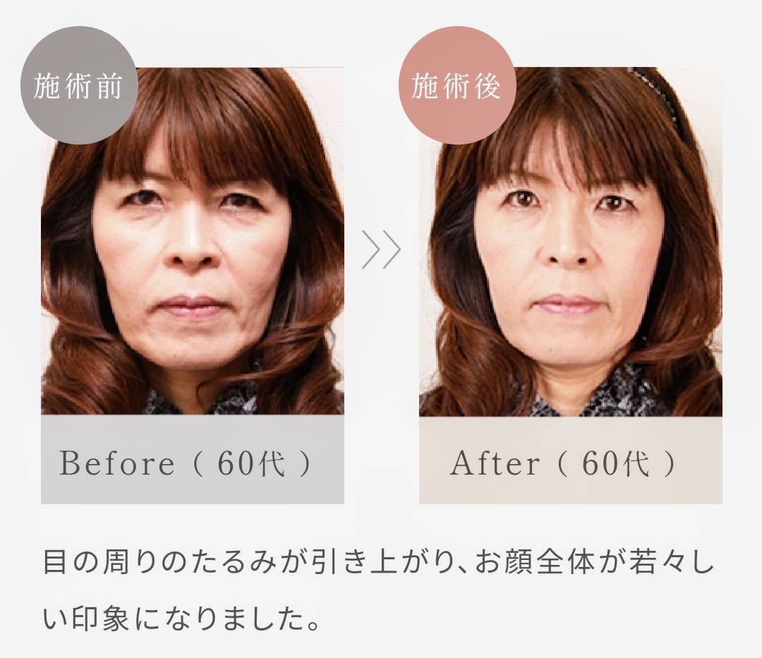 フェイスラインの変化